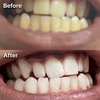 MEANSMILE™ - Pro Whitening Kit